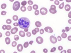Causas, síntomas y pautas de tratamiento para la anemia por deficiencia de B12