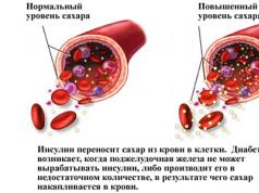 Hipoglucemia e hiperglucemia durante el embarazo, hipoglucemia congénita.